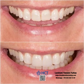 Laminate Veneers Turkey guarantees patient satisfaction with expertly tailored Laminate Teeth.
