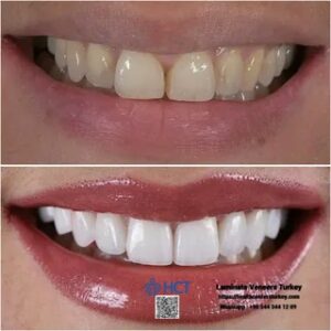 Laminate Veneers Turkey 17 Laminate Veneers Turkey offers a natural-looking alternative to crowns with Laminate Teeth.