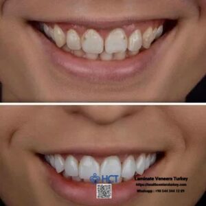 Laminate Veneers Turkey 18 Laminate Veneers Turkey ensures a long lifespan with proper care for Laminate Teeth.