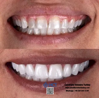 Laminate Veneers Turkey combines artistry and technology to create perfect Laminate Teeth.