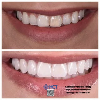 Laminate Veneers Turkey makes achieving a Hollywood smile possible with Laminate Teeth.