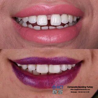 Composite Bonding Turkey - Restoring dental aesthetics and oral health with expert bonding solutions in Turkey.