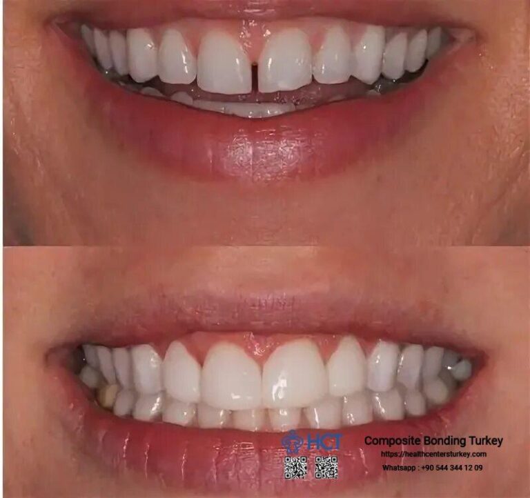 Composite Bonding Turkey - Achieve flawless teeth with quick and effective bonding procedures offered in Istanbul clinics.
