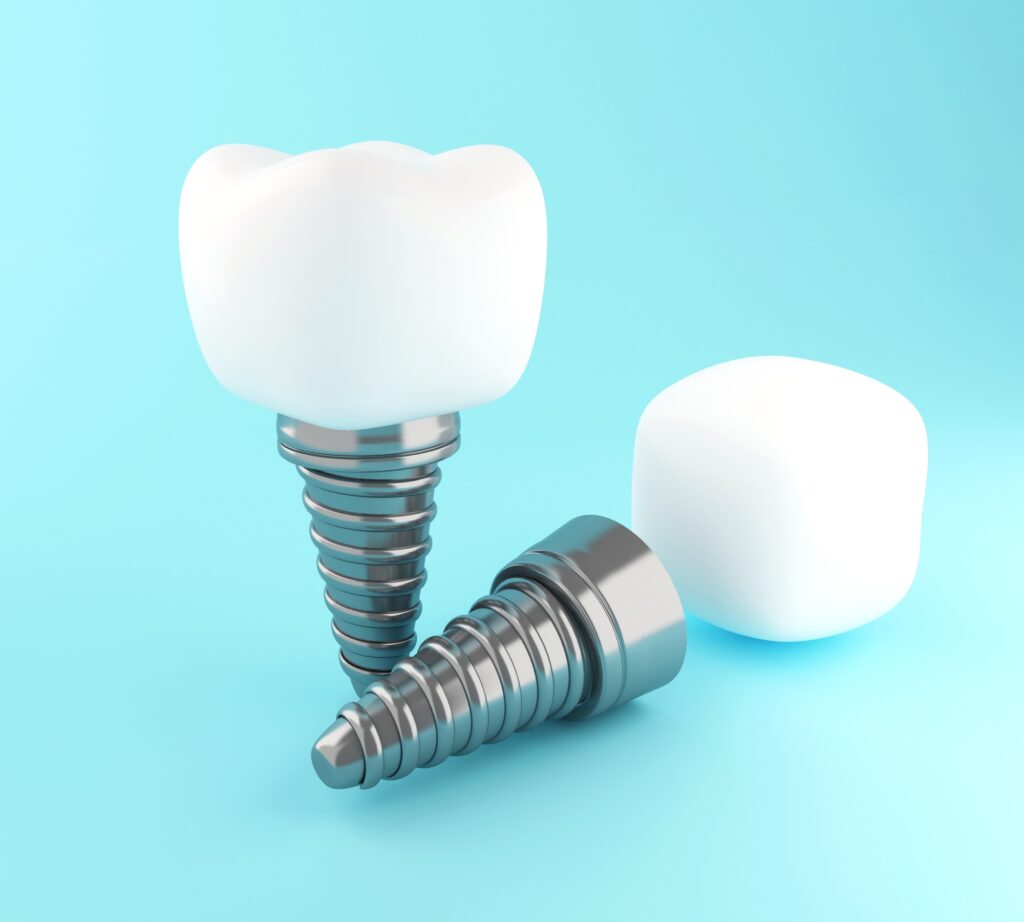 All-on-8 Implant Cost and Procedure in Turkey: Enhanced Stability for Full Mouth Restoration 2025 73 3d Dental tooth implant.