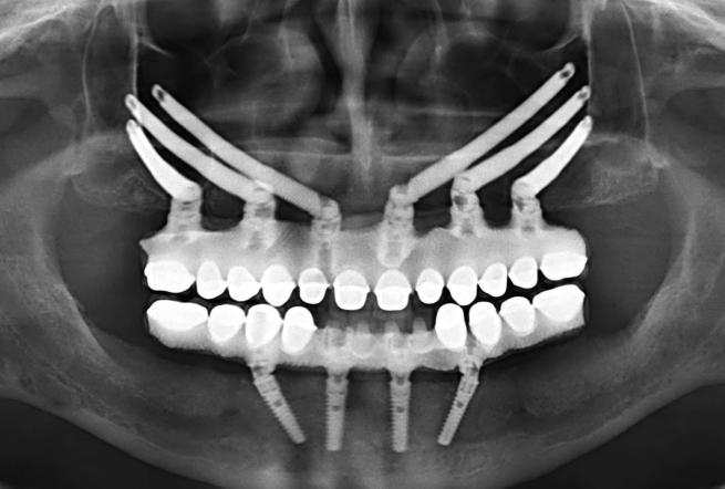 zygomatic implant x-ray after result from Hct Dental Clinic
