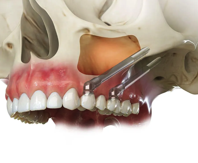 Zygomatic implants Turkey — cheekbone-anchored implants for severe bone loss, HCT Antalya