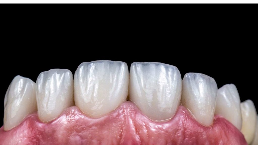 Zirconium vs E-Max Veneers Turkey: The Ultimate Material Comparison 149 e-max veneers turkey