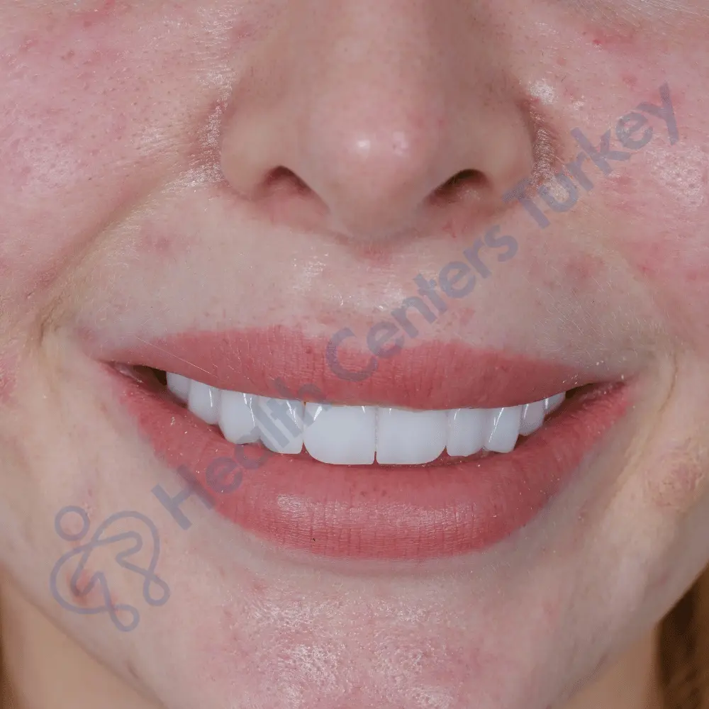 Laminate veneers Turkey before after - Sarah Elms smile makeover with cosmetic dentist at HCT Dental Clinic Antalya Turkey