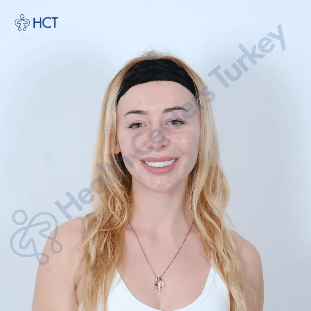 Sarah Elms laminate veneers Antalya Turkey - UK patient smile transformation before after at HCT Dental Clinic