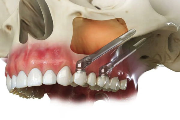 Zygomatic implant side view 3d Model